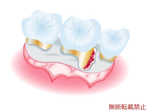 歯肉剥離搔爬術の流れ